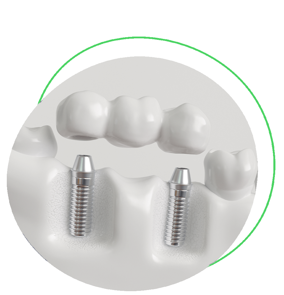 a dental bridge being placed onto dental implants