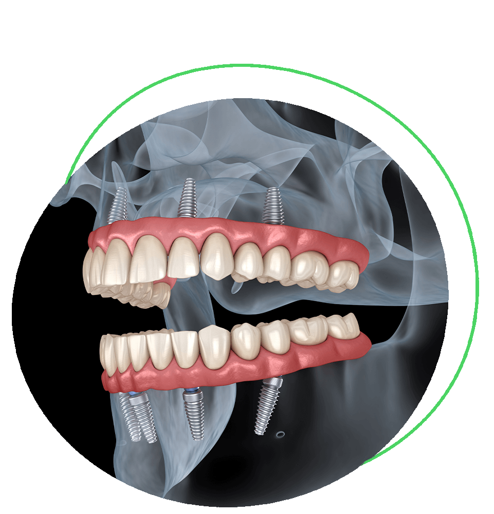 full mouth dental implants