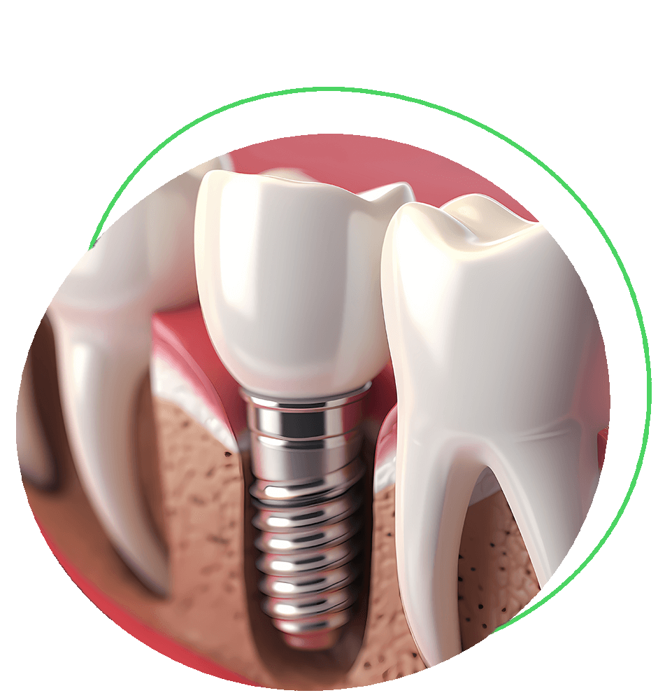 single dental implant