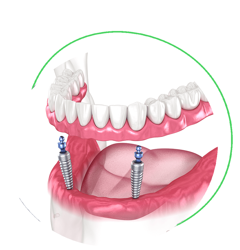 implant supported dentures